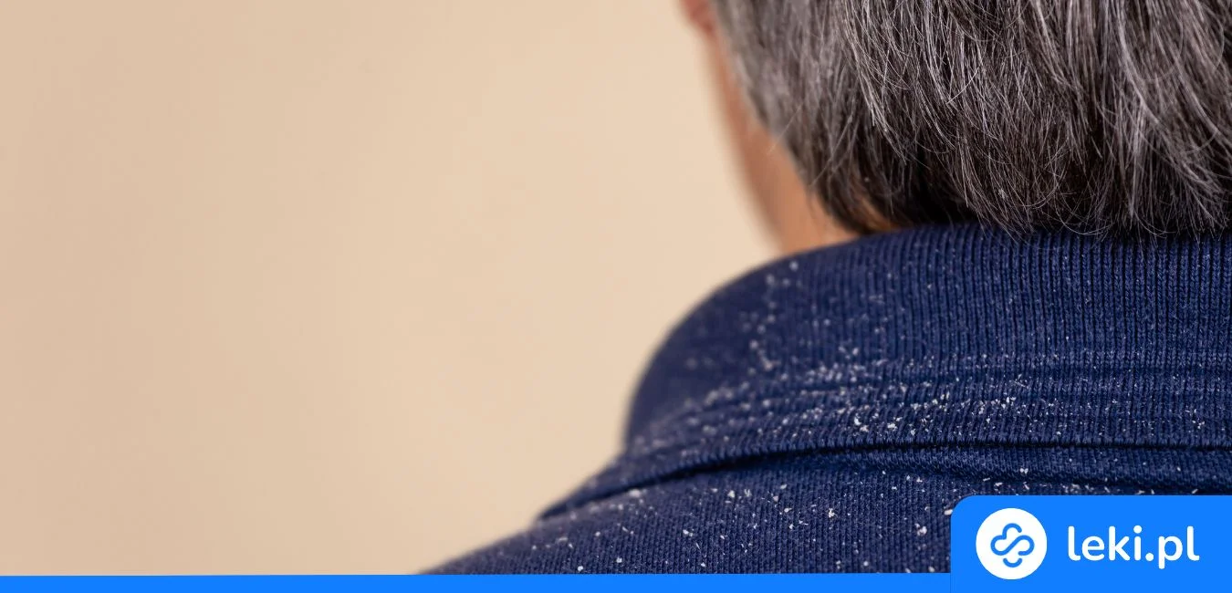 Jak pozbyć się łupieżu? Poznaj leki i domowe sposoby na łupież i zapomnij o problemie!