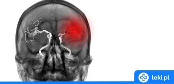 Ilustracja poradnika Na horyzoncie kolejny lek dla pacjentów z udarem niedokrwiennym?