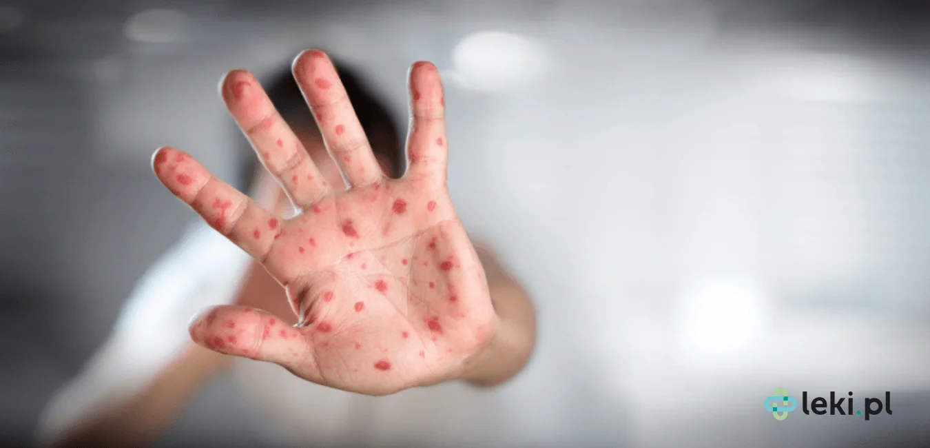 Odra – dlaczego szczepienia są kluczowe dla odporności zbiorowej?