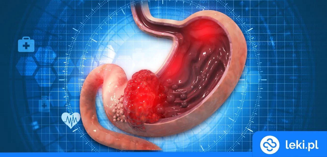 Rak żołądka – FDA zatwierdza pierwszą immunoterapię