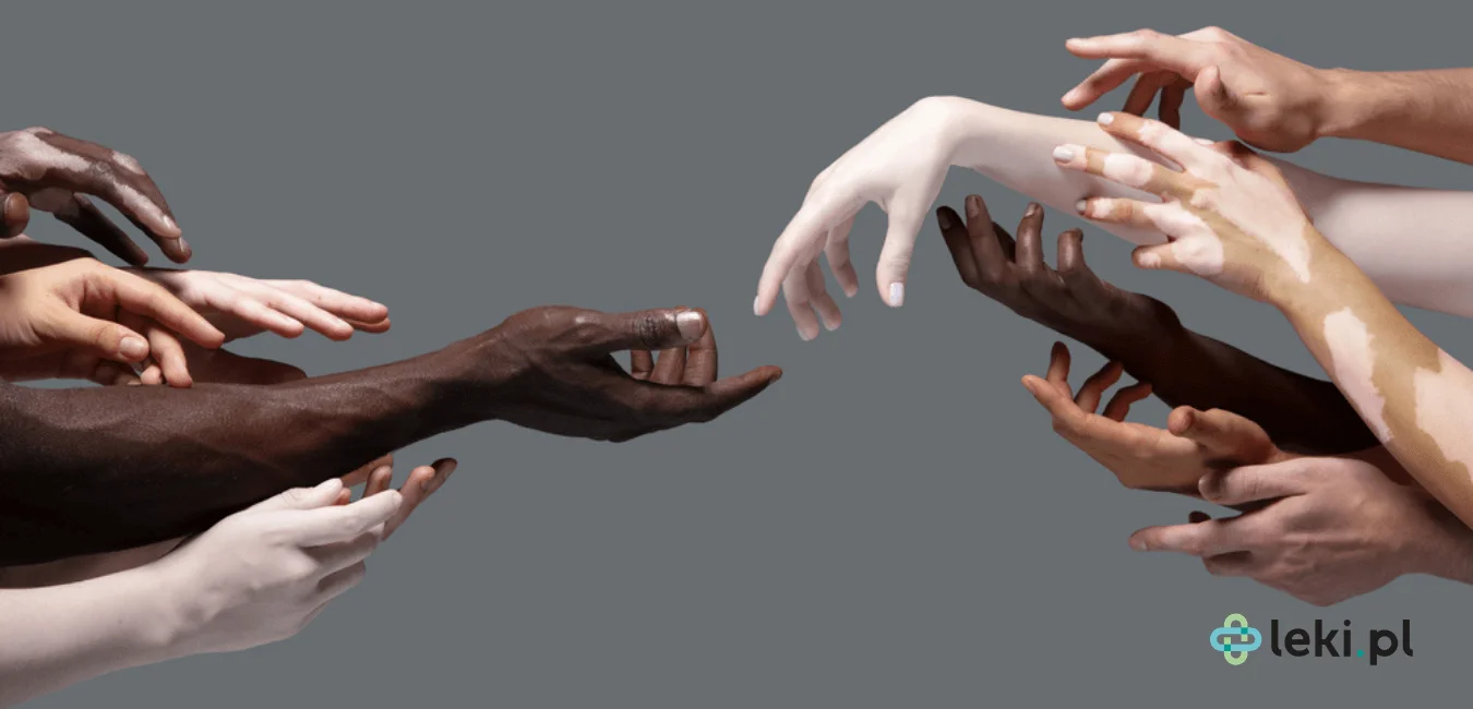 25 czerwca — Światowy Dzień Bielactwa. Czym jest ta choroba?