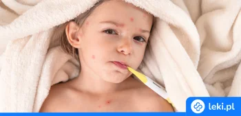 Ilustracja poradnika Ospa po szczepieniu – objawy, przebieg i skuteczność szczepionki