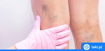 Ilustracja poradnika Poznaj tabletki i maści z kasztanowcem na żylaki i obrzęki!