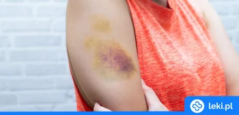 Ilustracja poradnika Jaka jest najlepsza maść na siniaki i krwiaki?