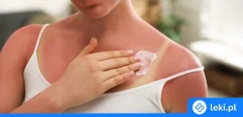 Ilustracja poradnika Czym smarować skórę po oparzeniu słonecznym?