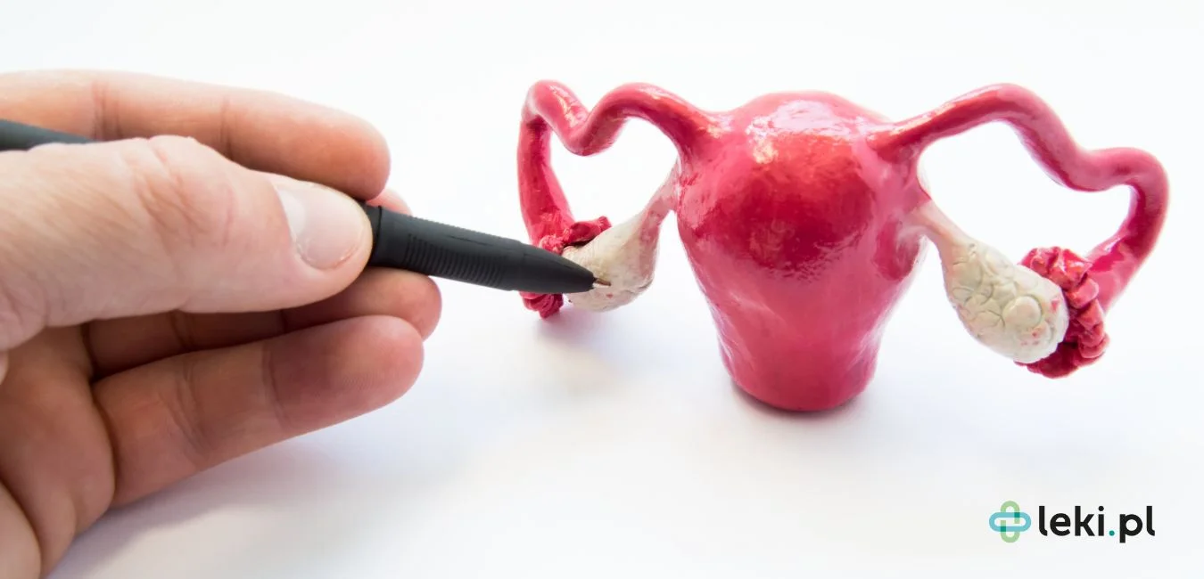 PCOS – objawy i sposoby leczenia