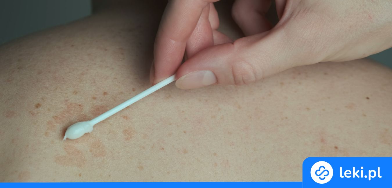 Łupież pstry – jak leczyć? Poznaj skuteczne maści, szampony i tabletki!