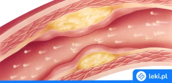 Ilustracja poradnika Jak leczyć miażdżycę? Poznaj przyczyny miażdżycy, jej objawy i metody leczenia