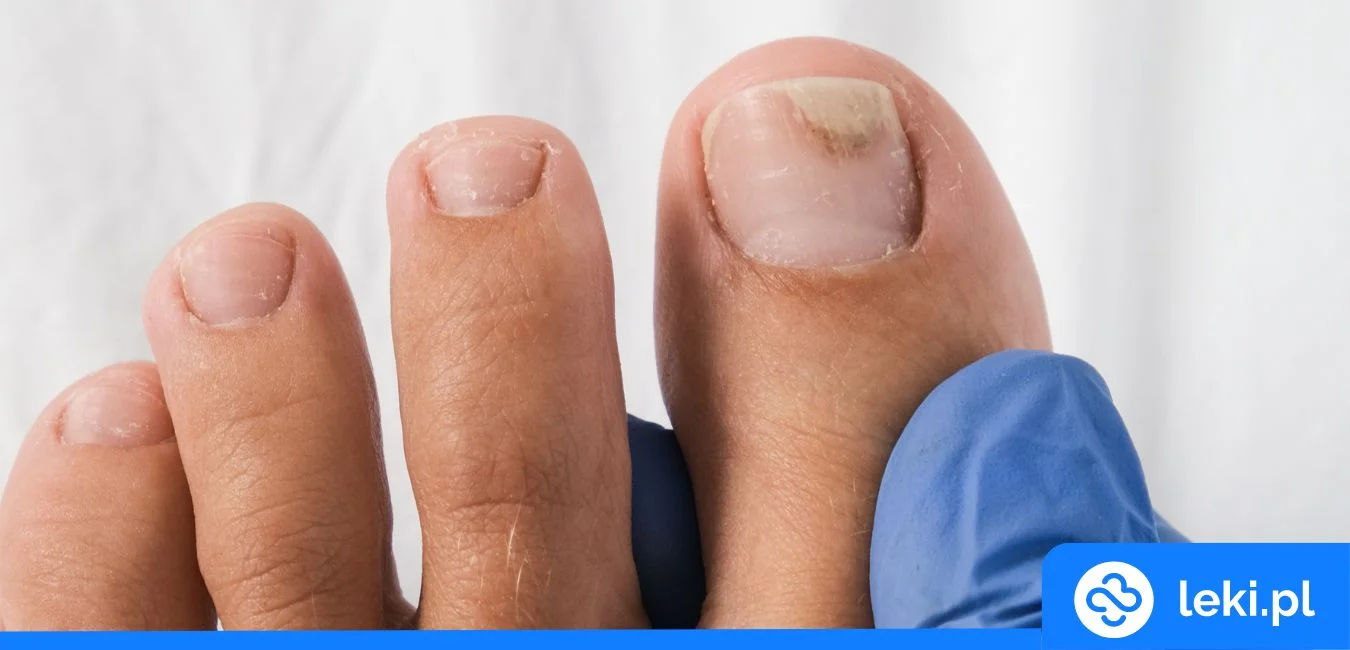 Onycholiza — skuteczne leczenie i leki bez recepty na paznokcie