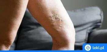 Ilustracja poradnika Co to jest zakrzepica żylna?