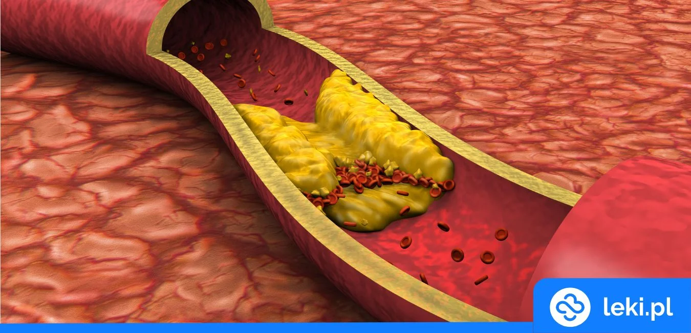 Jakie są leki na cholesterol nowej generacji?