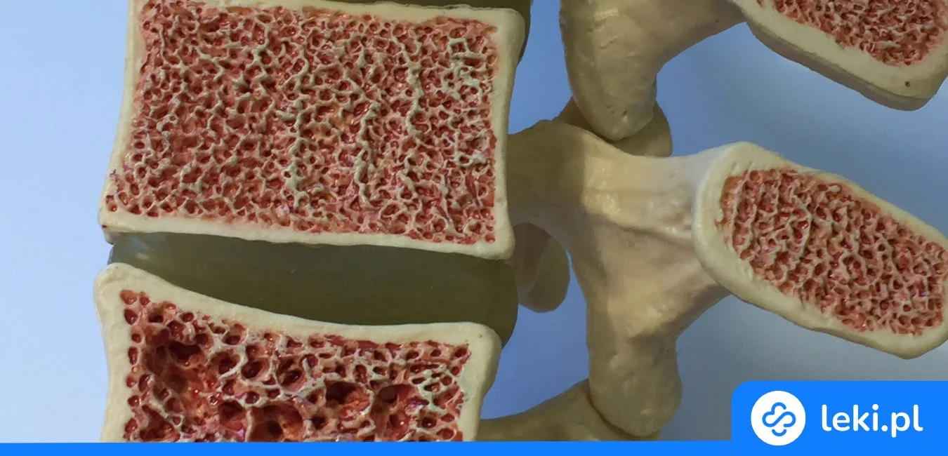 Nowoczesne leczenie osteoporozy – najskuteczniejsze leki i zastrzyki