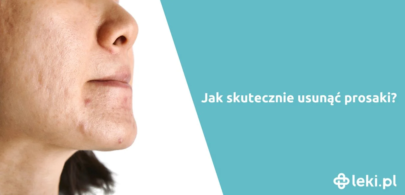 Jaka jest skuteczna maść na prosaki na powiece, twarzy i innych częściach ciała?