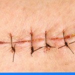 Czym smarować rany po szwach?