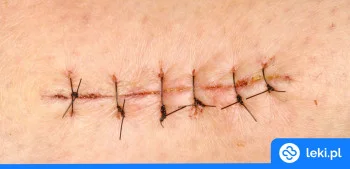 Ilustracja poradnika Czym smarować rany po szwach?