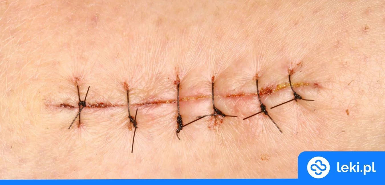 Czym smarować rany po szwach?