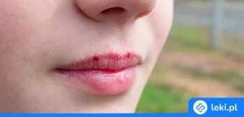 Ilustracja poradnika Spierzchnięte usta czy zapalenie czerwieni wargowej? Jak je rozpoznać i leczyć?