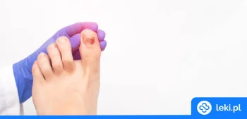 Ilustracja poradnika Co stosować na stłuczenie palca u nóg lub u ręki?
