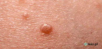 Ilustracja poradnika Mięczak zakaźny – leczenie i objawy