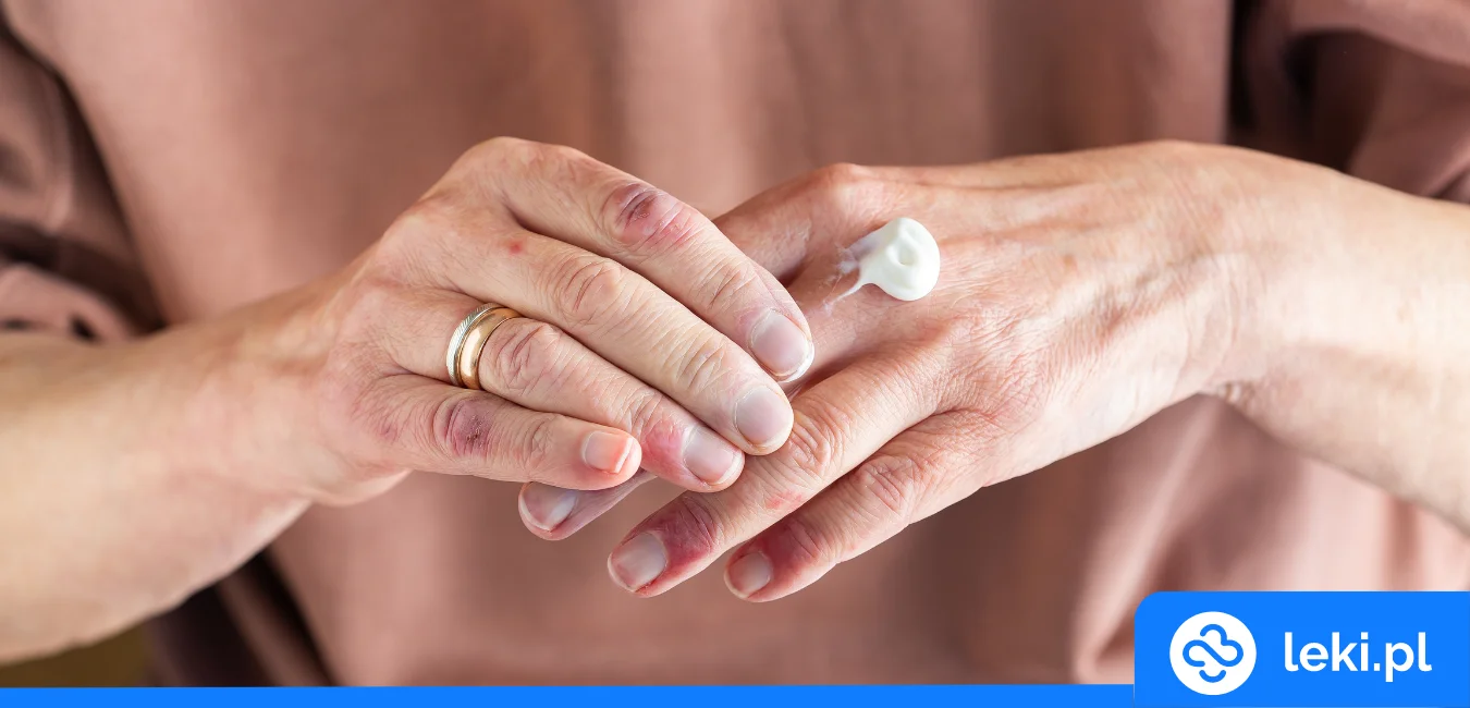 Poznaj kremy na atopowe zapalenie skóry bez recepty!