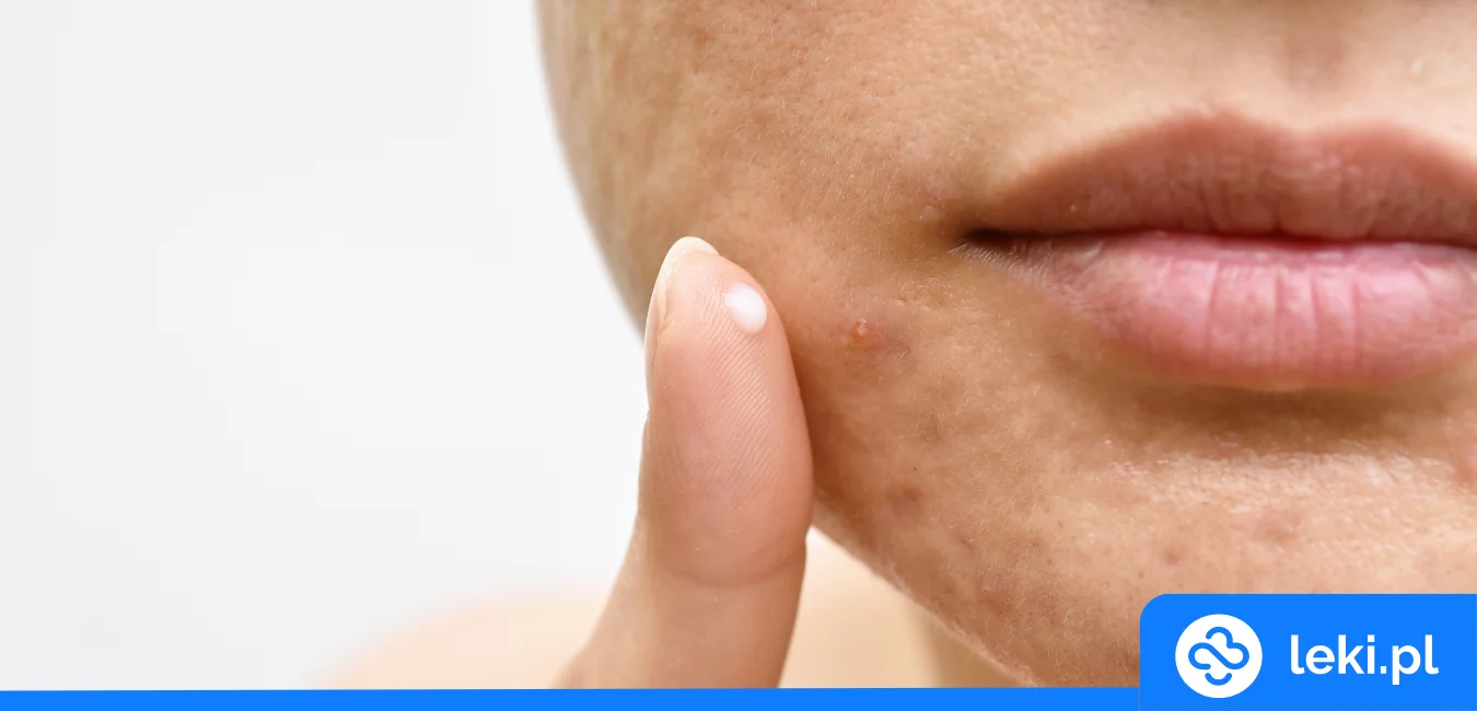 Jakie są dobre kremy do cery trądzikowej z apteki?