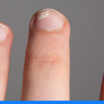 Białe plamy na paznokciach – przyczyny, leczenie i profilaktyka