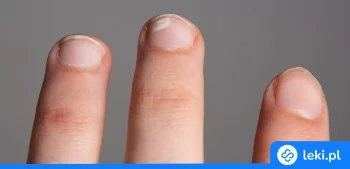 Ilustracja poradnika Białe plamy na paznokciach – przyczyny, leczenie i profilaktyka