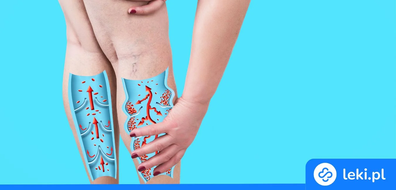 Najlepsze maści i żele na żylaki nóg. Co warto kupić w aptece?