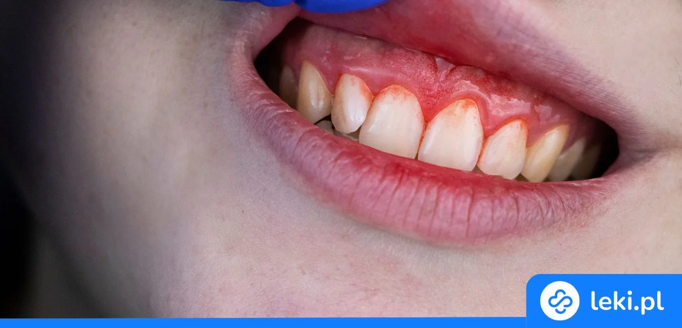 Najlepsze tabletki do ssania i żele z koenzymem Q10 na dziąsła