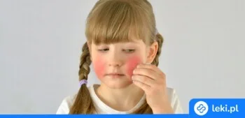 Ilustracja poradnika Rumień zakaźny u dziecka — czym jest i jak wygląda?