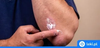 Ilustracja poradnika Maść z żyworódki pierzastej – jak działa i jak ją stosować?