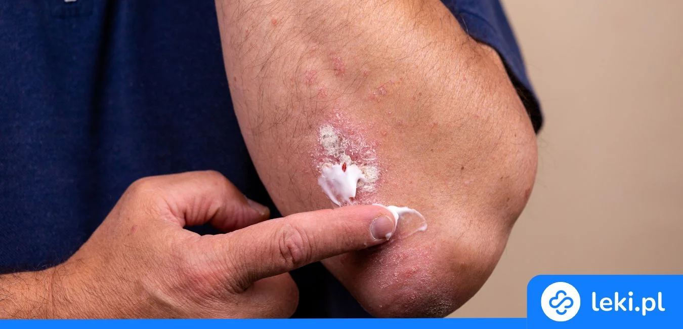 Maść z żyworódki pierzastej – jak działa i jak ją stosować?