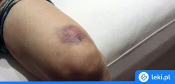 Ilustracja poradnika Domowe sposoby na podniesienie poziomu płytek krwi