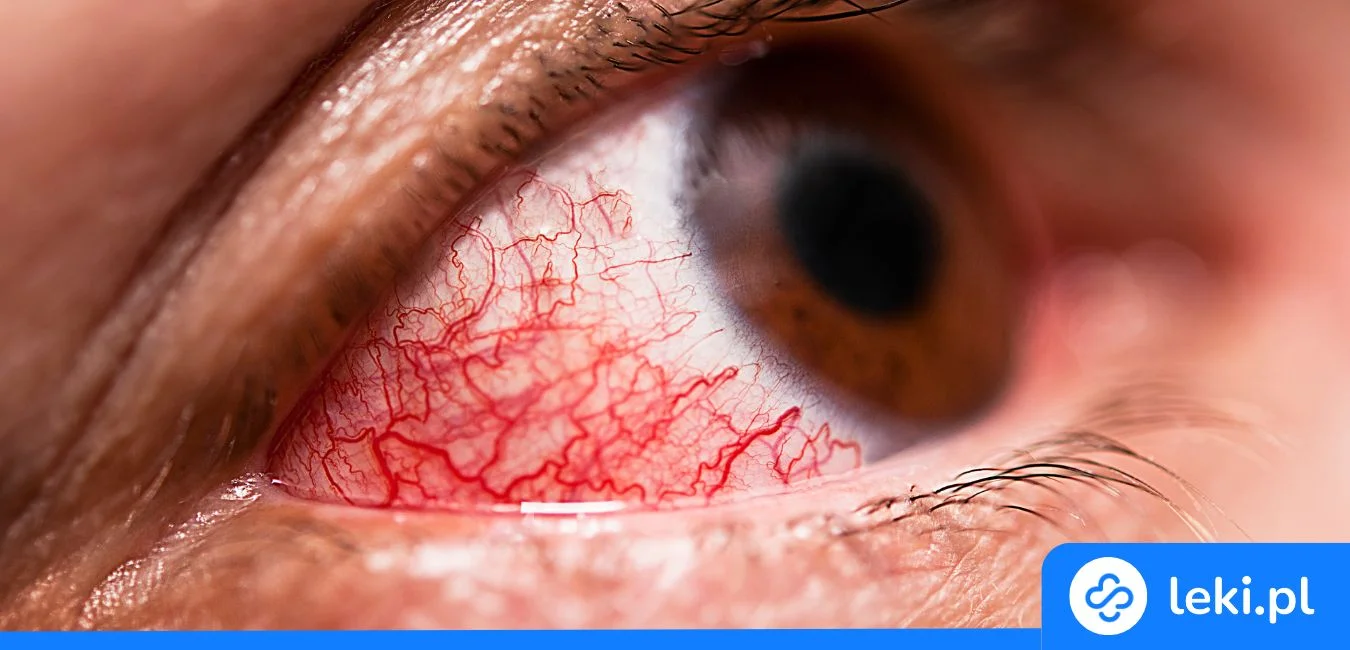 Dziwna wydzielina w oku? Zastosuj krople z antybiotykiem bez recepty!