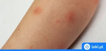 Ilustracja poradnika Co zrobić z pogryzieniem przez pluskwy?