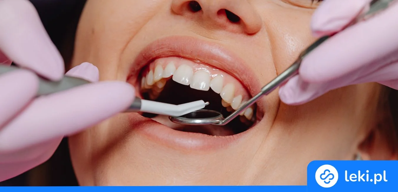 Wypadła plomba? Sprawdź, jak działa tymczasowa plomba z apteki!