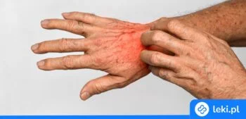 Ilustracja poradnika Czym jest egzema na dłoniach i jak ją rozpoznać?