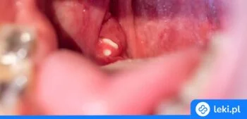 Ilustracja poradnika Jak bezpiecznie usunąć kamienie migdałkowe? Sprawdź domowe sposoby!