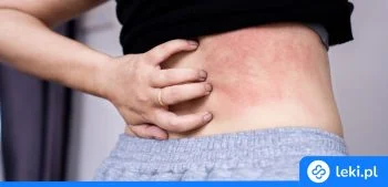 Ilustracja poradnika Wysypka od potu – jak rozpoznać i skutecznie leczyć potówki