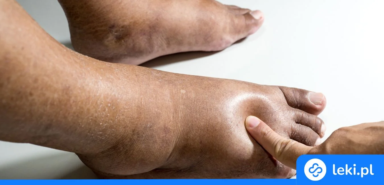 Skuteczny lek na stopę cukrzycową – jak chronić stopy przed powikłaniami cukrzycy?