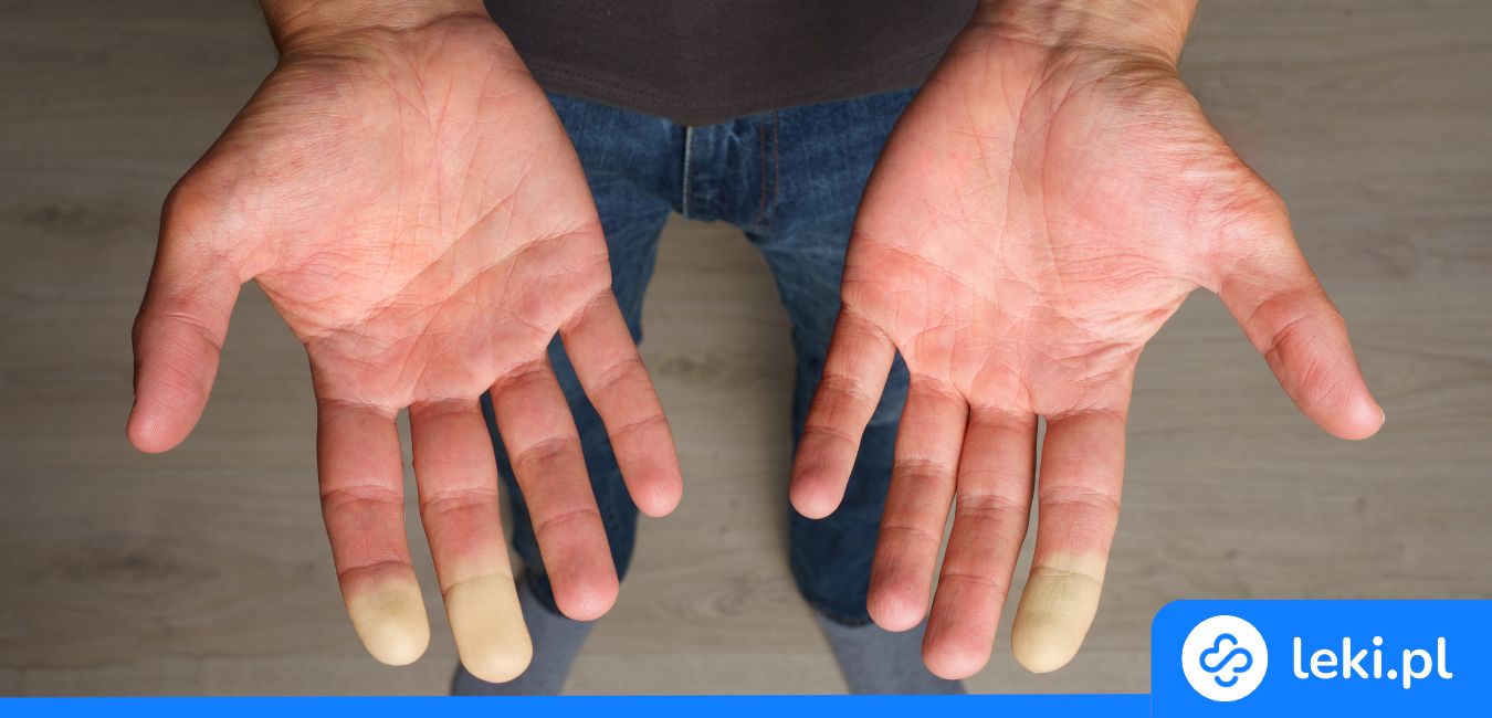 Czy masz zespół Raynauda? Zobacz objawy i rozpocznij leczenie dziś!