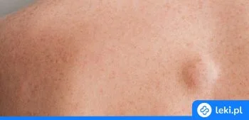 Ilustracja poradnika Czy istnieje skuteczny lek na tłuszczaki? Fakty i mity o leczeniu