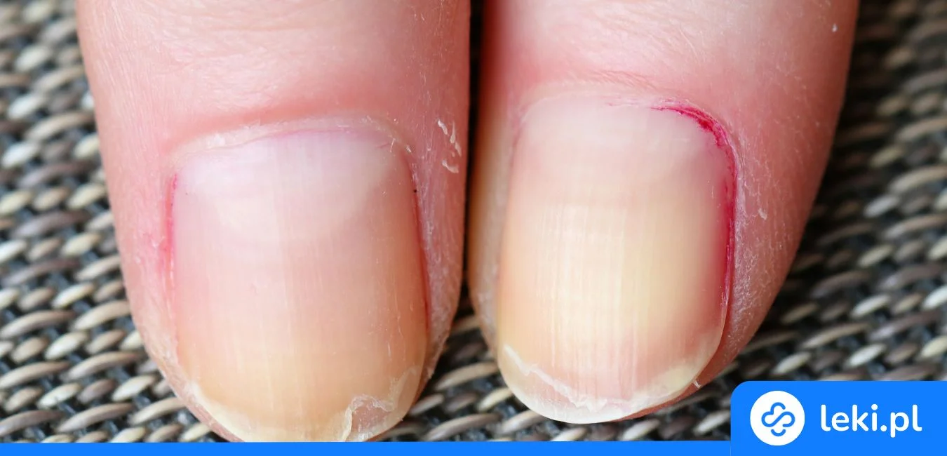 Dlaczego paznokcie się rozdwajają? Poradnik dla pacjenta