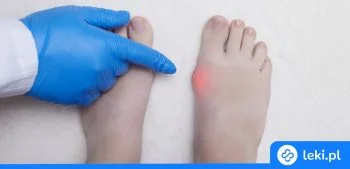 Ilustracja poradnika Akcesoria na haluksy – jak skutecznie ulżyć stopom i zmniejszyć ból?