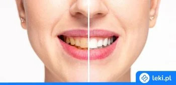 Ilustracja poradnika Przebarwienia na zębach – przyczyny, rodzaje i skuteczne sposoby usuwania