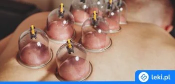 Ilustracja poradnika Jakie wybrać bańki lekarskie? Ogniowe czy bezogniowe – porównanie