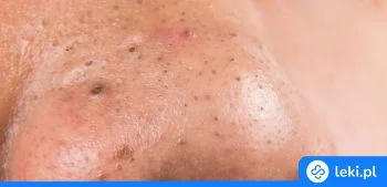 Ilustracja poradnika Jaki krem na zaskórniki z apteki wybrać? Poradnik dla każdego